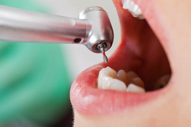 Best Emergency Wisdom Teeth Removal in Ashton, ID